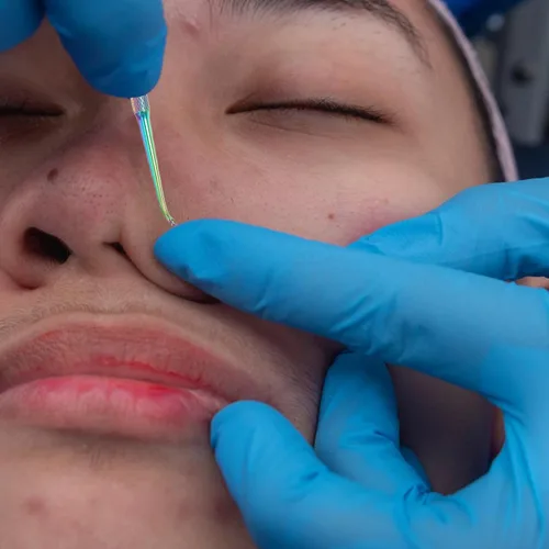 Miniatura 4 de Lurrose Herramienta extractora de comedones de acero inoxidable, removedor de cabeza negra, limpiador de poros, agujas de belleza ocultas