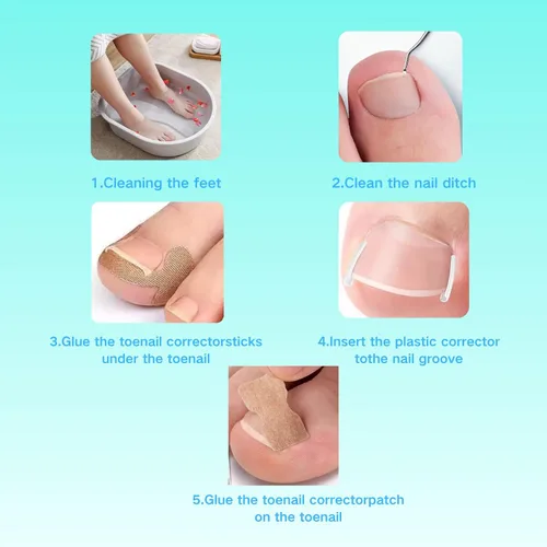 Miniatura 4 de Juego de corrector de uñas encarnadas con parche de corrección de uñas curvas, kit de eliminación de uñas mejorado, herramientas de pedicura