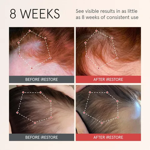 Miniatura 2 de iRESTORE Suero para el cuero cabelludo Suero para el crecimiento del cabello para mujeres y hombres Lo mejor para adelgazamiento del cabello