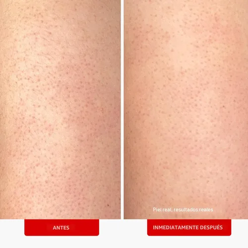 Miniatura 3 de First Aid Beauty Exfoliante corporal KP Bump Eraser con 10% AHA, exfoliante de piel de queratosis pilaris con ácidos glicólicos y lácticos