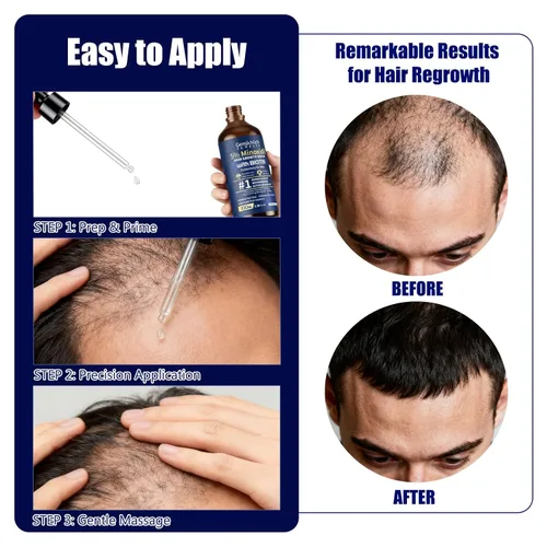 Miniatura 4 de 5% de minoxidil para el crecimiento del cabello con biotina, 3.4 fl oz de suero tópico de solución de minoxidil con romero y cafeína para 5%