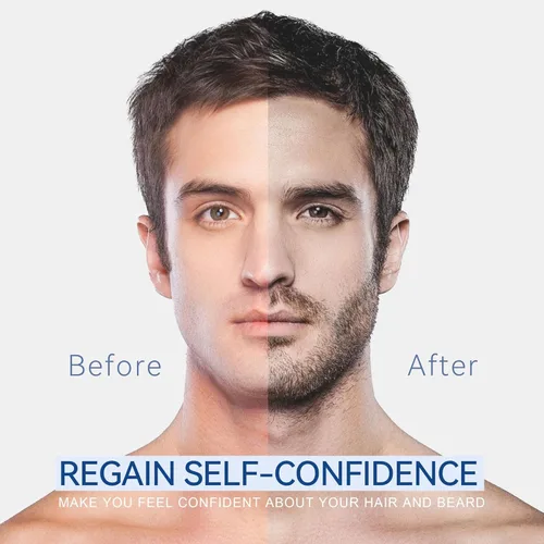 Miniatura 4 de FluMisch 5% de espuma de minoxidil para hombres, 5% biotina y 5% mininoxidil uso para el crecimiento del cabello, ralentiza la pérdida de cabello