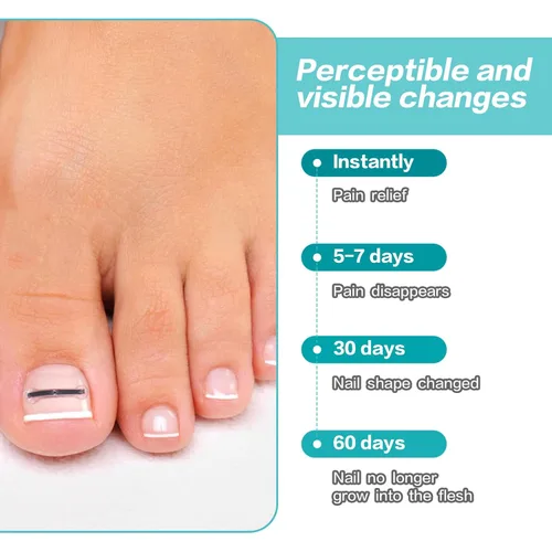Miniatura 7 de Herramienta de tratamiento de uñas encarnadas de aleación de titanio, kit de eliminación de uñas de los pies para reparación de uñas curvas, 10