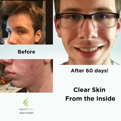 Miniatura 4 de Clear Skin - Paquete de vitaminas para el acné 20 antioxidantes, botánicos, minerales y vitaminas Pastillas hormonales y quísticas para el acné