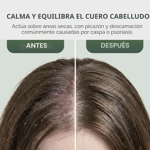 Miniatura 5 de Spray Acondicionador de Permanencia - Tratamiento del Cuero Cabelludo con Árbol de Té - Tratamiento Anti-Caspa y para Cuero Cabelludo Seco