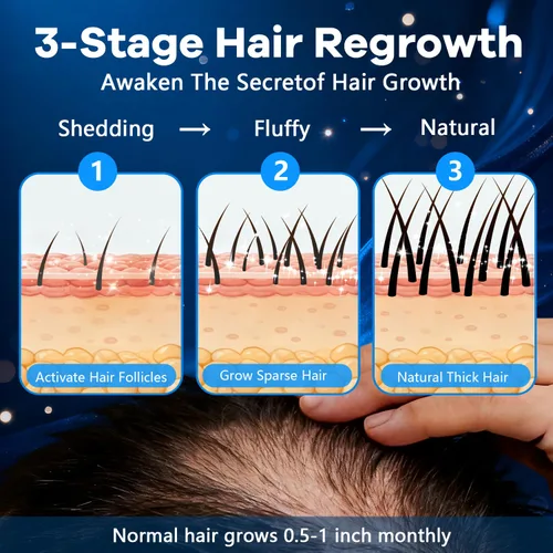 Miniatura 5 de Espuma tópica de minoxidil al 5 %, aerosol de minoxidil para hombres, impregnado con biotina, tratamiento para el crecimiento del cabello, apoya