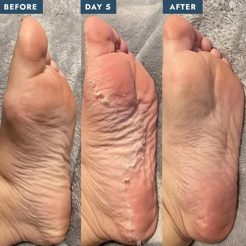 Miniatura 5 de VOESH - Calcetines exfoliantes para peeling, un par de máscaras de pies, peeling de pies, calcetines de máscaras de pies, removedor de callos