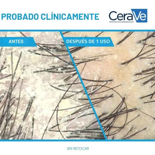 Miniatura 4 de CeraVe Champú Hidratante Anticaspa, Tratamiento de Caspa con Zinc Piritiona al 1% con Ceramidas, Niacinamida y Ácido Hialurónico, Ayuda a Eliminar