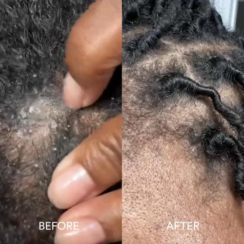 Miniatura 9 de Dermazen Champú limpiador de terapia del cuero cabelludo para tipos de piel de dermatitis seborreica Reduce visiblemente la descamación y alivia