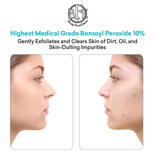 Miniatura 4 de Tratamiento de lavado facial para acné con peróxido de benzoilo – Combate las imperfecciones del acné al contacto para brotes quísticos, piel grasa