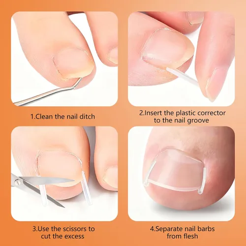 Miniatura 6 de Juego de corrector de uñas encarnadas con tiras correctoras, juego profesional de herramientas de pedicura para uñas encarnadas para hombres