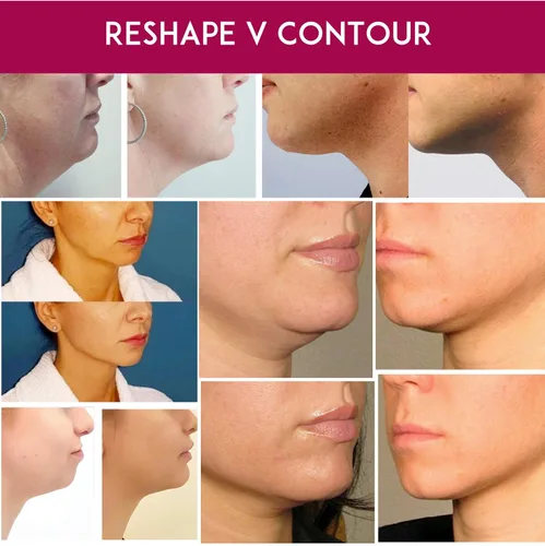 Miniatura 4 de Máscara facial – Jawline Lift Enhancer Face Reafirming Skin Tightening Skin Up Funciona para la línea V Máscara de cuello para mujeres y hombres