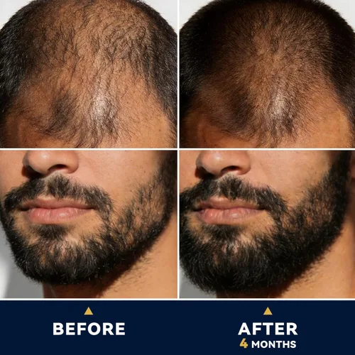 Miniatura 3 de Minoxidil para hombres Suero para el crecimiento de la barba: Extra Strength 5% Minoxidil Spray para hombres Tratamientos de crecimiento de barba