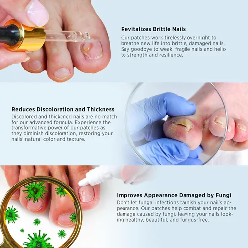 Miniatura 4 de Tratamiento de hongos en las uñas de los pies extra fuerte – Tratamiento de hongos en las uñas para uñas de los pies extra fuerte – Parches
