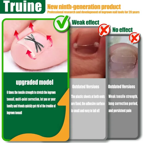 Miniatura 2 de Corrector de uñas encarnadas de titanio mejorado, tratamiento de uñas encarnadas, adecuado para uñas curvas, kit de eliminación de uñas encarnadas