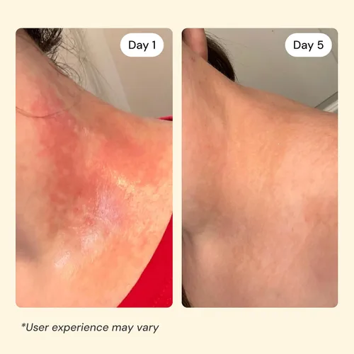 Miniatura 4 de MyMagicHealer Universal Flare Care Sin aceite esencial Alivio para erupciones, eczema, psoriasis, hidradenitis supurativa, impétigo, dermatitis