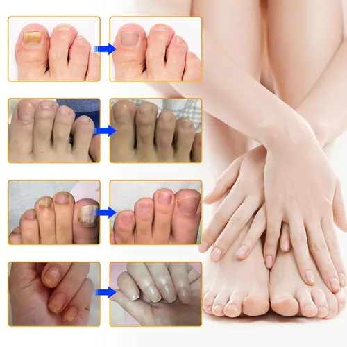 Miniatura 6 de Tratamiento de uñas de los pies extra fuerte, 8 horas de reparación de uñas durante la noche, tratamiento de uñas encarnadas, fortalece las uñas
