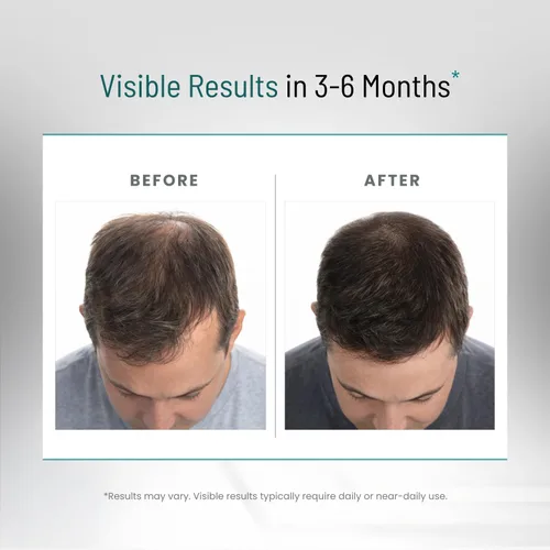 Miniatura 7 de Bloqueador de DHT para hombres Fórmula ultra potente para el crecimiento del cabello Saw Palmetto, Biotina, semilla de calabaza, extractos