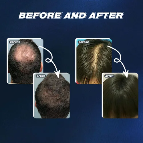 Miniatura 7 de Crecimiento del cabello de minoxidil al 5% para hombres y mujeres: rebrote tópico del pelo de la barba de minoxidil más grueso previene la pérdida
