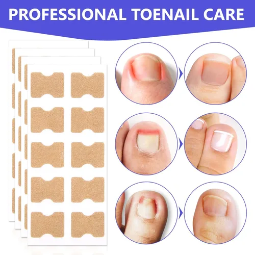Miniatura 4 de Parche corrector de uñas encarnadas, 100 tiras correctoras de uñas encarnadas, parches de corrección de uñas de los pies, herramienta de tratamiento