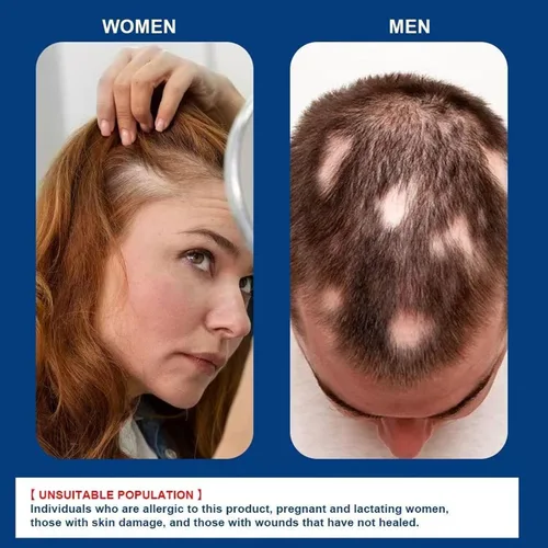 Miniatura 3 de Crema de masaje de cuero cabelludo de minoxidil al 5% para el crecimiento del cabello, cuidado profesional del cabello, tratamiento anti pérdida