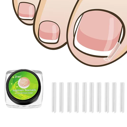 Tiras correctoras de uñas encarnadas profesionales, 50 tiras correctoras de uñas encarnadas, tiras curvadas para enderezar las uñas del pie, clips