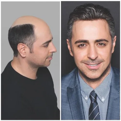 Miniatura 5 de 1B20 unidades de cabello gris Toupee para hombres piezas para hombre NLW sistema de reemplazo de heredero humano europeo para hombres 10x8 "toupee