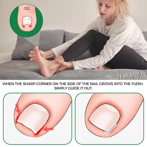 Miniatura 2 de Kit de eliminación de uñas encarnadas, tiras alisadoras de uñas sin dolor, 60 piezas, levantador de uñas y tijeras pequeñas, juego de corrector