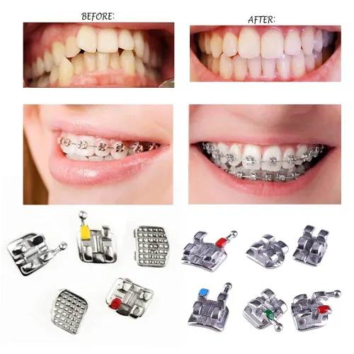 Miniatura 8 de VEZE Soportes dentales, 5 juegos de 100 piezas Mini Roth 022 ranura 345 ganchos, unido, compatible con MBT, unisex, uso en interiores, tema de salud