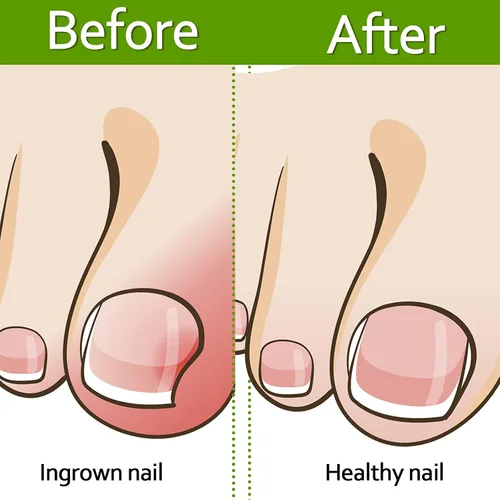 Miniatura 5 de 100 tiras correctoras de uñas encarnadas, parches de corrección de uñas de los pies, parches curvos para enderezar las uñas de los pies, clips