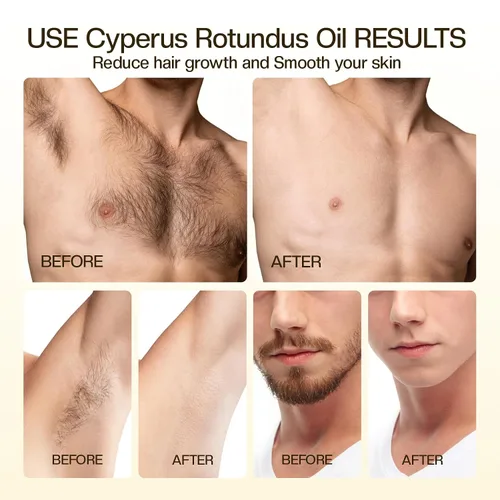 Miniatura 4 de Aceite Cyperus Rotundus para Depilación: 60s Absorción Rápida Previene el Vello Encarnado Reduciendo e Inhibiendo el Crecimiento del Cabello en 68