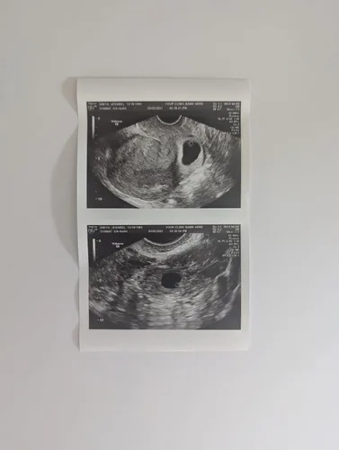 Miniatura 3 de Broma de ultrasonido 2D personalizada falsa con dos fotos conectadas B&W