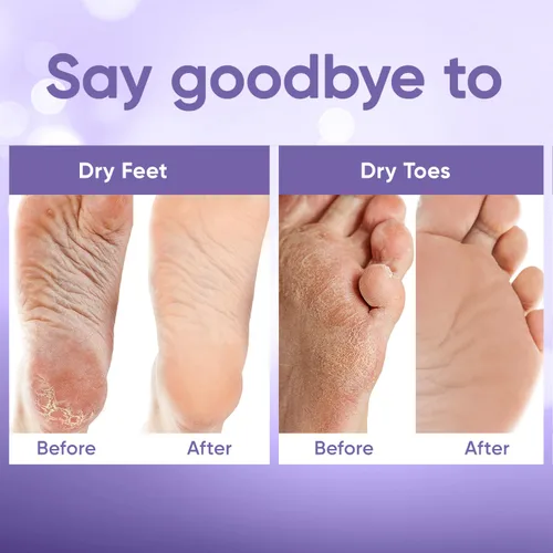 Miniatura 5 de Máscara exfoliante para pies - Máscara para pies con piel suave de bebé - Elimina la piel muerta, seca, agrietada y callos, spa para pies, hecha
