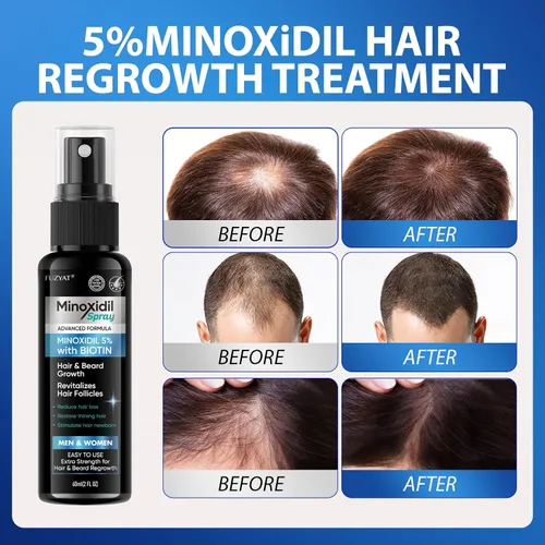 Miniatura 3 de Minoxidil al 5% para tratamiento de pérdida de cabello para hombres, minoxidil para mujeres, aerosol para el crecimiento del cabello, para hombres