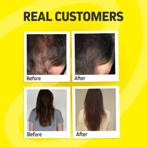 Miniatura 4 de Vitaminas para el crecimiento del cabello para mujeres y hombres Bloqueador DHT con palma enana americana y 10000 mcg de biotina, suplemento