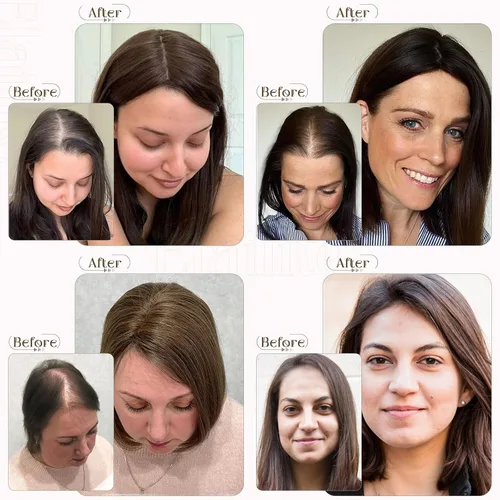 Miniatura 5 de Elailite Toppers para el cabello para mujer, cabello humano real, separación libre para adelgazar el cabello, piezas de cabello para pérdida