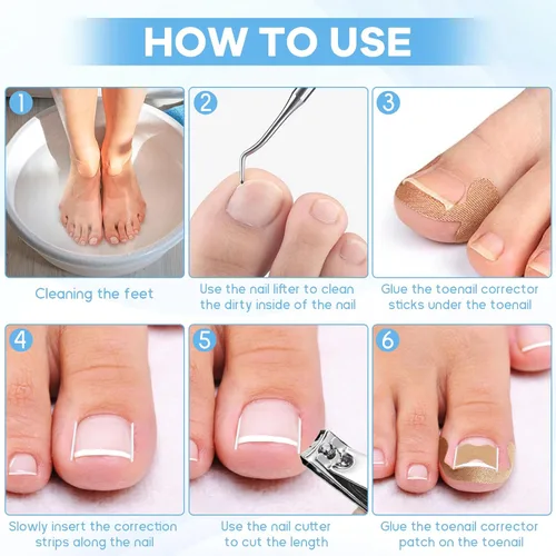 Miniatura 4 de Kit de eliminación de uñas encarnadas con tiras de uñas encarnadas, parche corrector de uñas curvas, lima de uñas y herramientas de pedicura