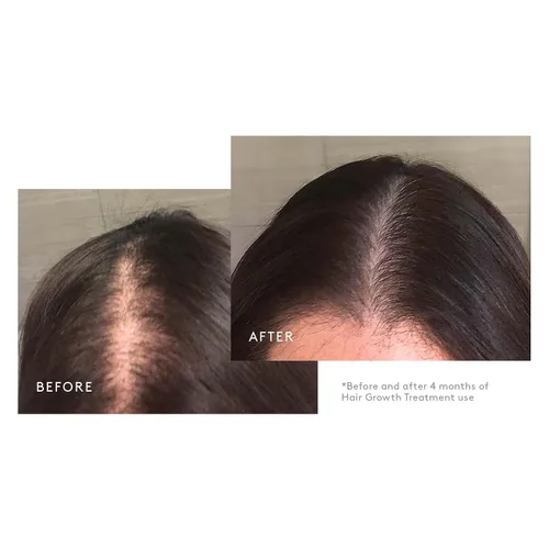 Miniatura 6 de Virtue Flourish Régimen de crecimiento del cabello para mujeres con minoxidil 5% espuma para cabello fino o adelgazante, sin sulfato, seguro