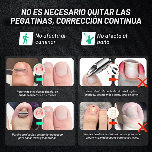 Miniatura 2 de Tratamiento de uñas encarnadas de aleación de titanio, herramientas de uñas y kit de eliminación de uñas encarnadas especialmente diseñado