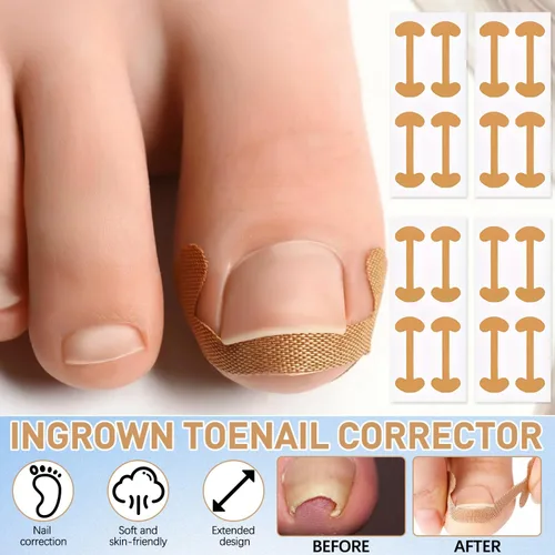 Miniatura 5 de Kits de corrector de uñas encarnadas con tiras curvas, parches transpirables y herramientas de pedicura, juego de cuidado de uñas para una