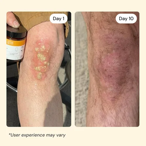 Miniatura 5 de MyMagicHealer Universal Flare Care Sin aceite esencial Alivio para erupciones, eczema, psoriasis, hidradenitis supurativa, impétigo, dermatitis
