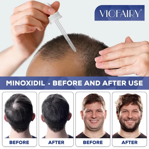 Miniatura 2 de 5% de mininoxidil para hombres y mujeres, suero de biotina para el crecimiento del cabello, tratamientos de recrecimiento de barba y cabello