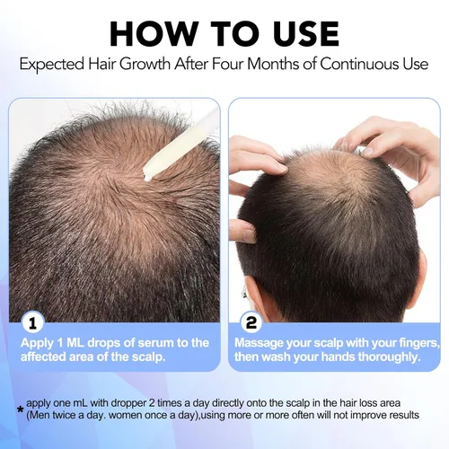 Miniatura 5 de Minoxidil para hombres - 5% extra fuerte crecimiento del cabello para hombres tratamiento-5% solución tópica aplicador gotero incluido -Minoxidil