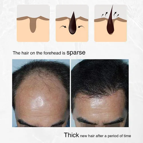Miniatura 5 de Spray 3 en 1 para el crecimiento del cabello con romero, cebolla y semillas negras - Controla la pérdida y promueve el crecimiento A-Spray