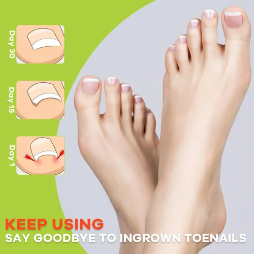 Miniatura 4 de Kit corrector de uñas encarnadas, herramientas de uñas, tiras de corrección transpirables con herramientas de levantamiento de uñas, cortaúñas