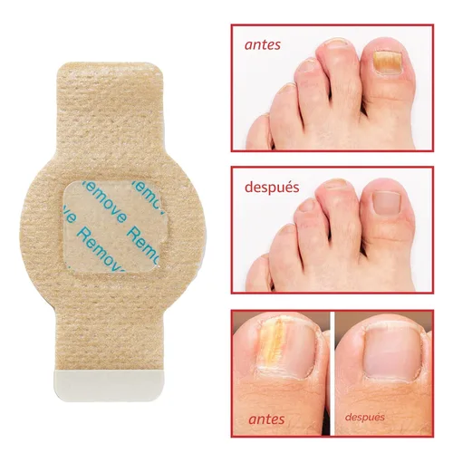 Miniatura 2 de Parches de uñas fúngicas – Tratamiento de uñas de los pies extra fuerte 21 piezas – Reparación de uñas para restaurar uñas dañadas y apariencia