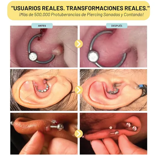 Miniatura 5 de BASE LABORATORIES Gel Eliminador de Protuberancias Queloides Tratamiento Natural para Protuberancias de Piercing y Gel para Cicatrices Queloides