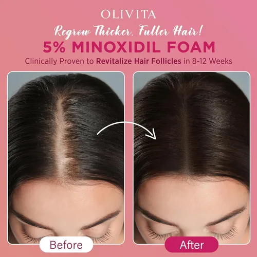 Miniatura 2 de 5% de espuma de minoxidil para el crecimiento del cabello de las mujeres: tratamiento de crecimiento del cabello extra fuerte - Solución de pérdida