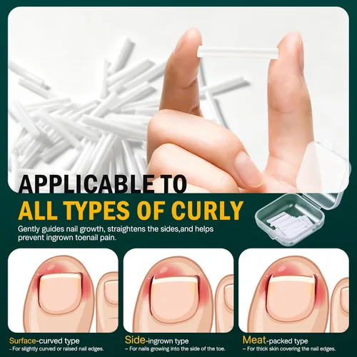Miniatura 2 de FVION Juego de corrector de uñas encarnadas – 40 tiras alisadoras de uñas encarnadas sin dolor con levantador de uñas de los pies – Solución eficaz