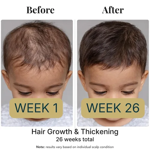 Miniatura 6 de REVATOLOGY - Producto para el crecimiento del cabello para niños y bebés, aceite de alta potencia para el cuero cabelludo y el cabello